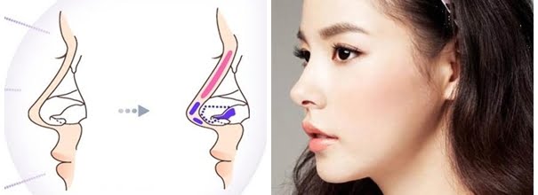 Lấy sụn vành tai tạo hình đầu mũi
